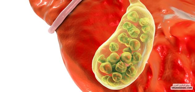 هل حصوات المراره لها علاقه بالنباتيه؟