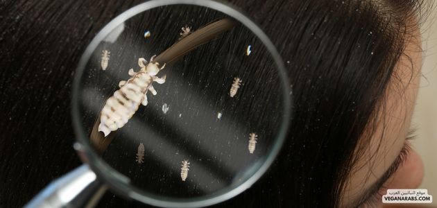 كيف أعرف أن القمل اختفى من شعري؟ How do I know if the lice have disappeared from my hair