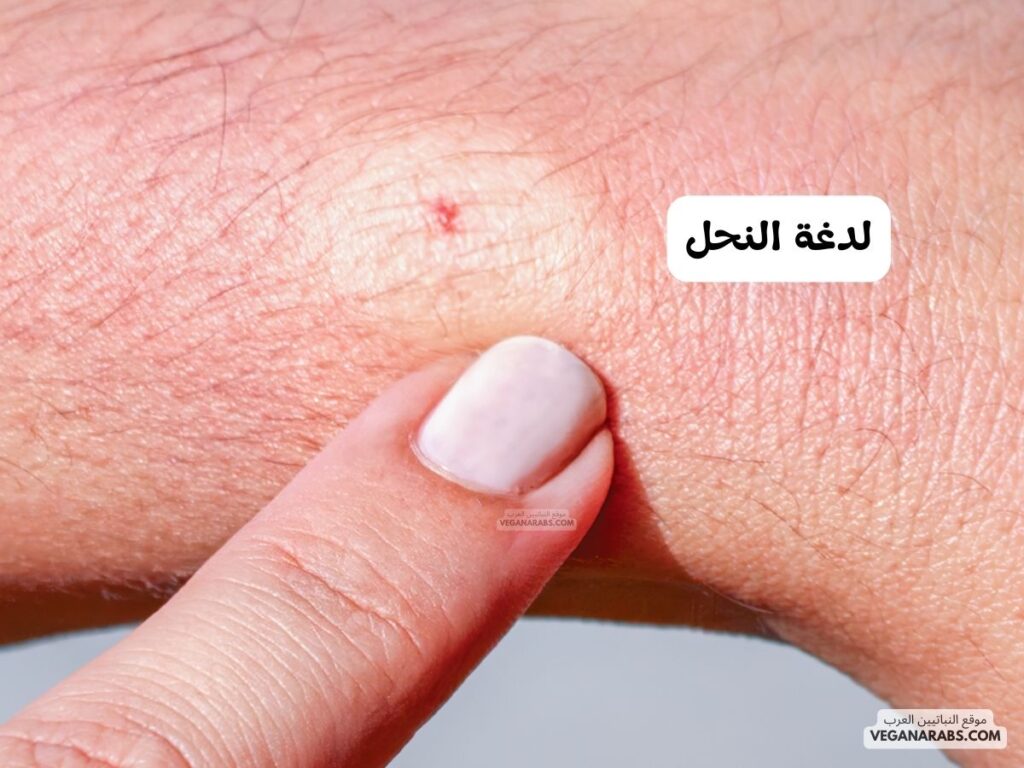 لدغة النحل
