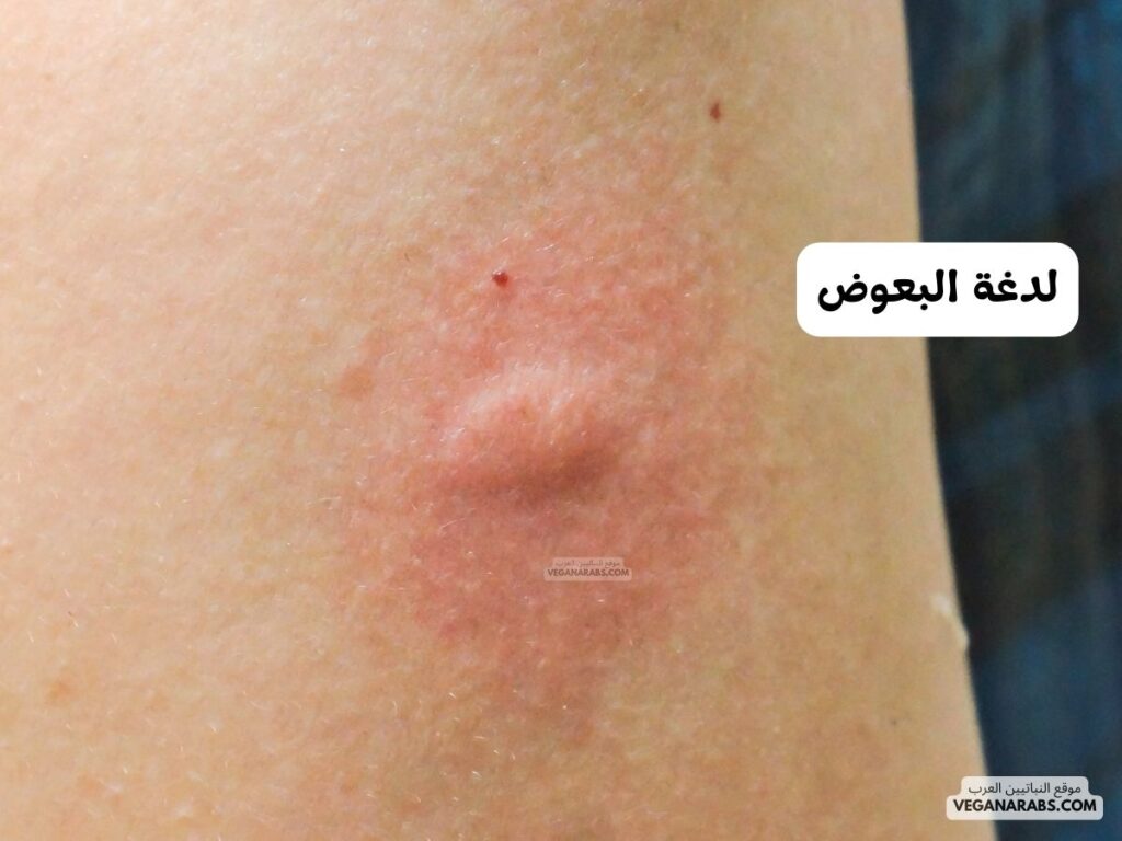 2- لدغة البعوض