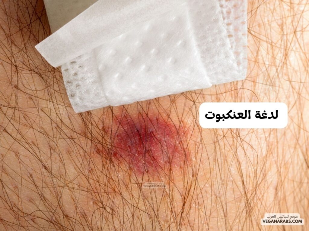 3- لدغة العنكبوت