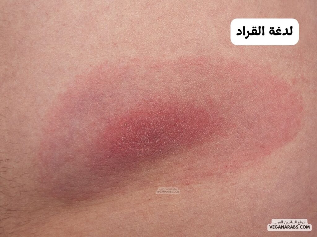  لدغة القراد