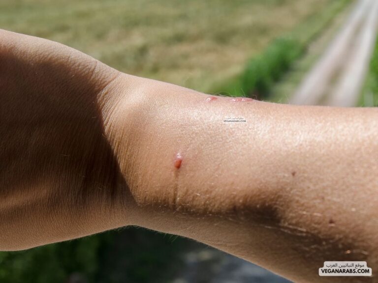 قرصة عنكبوت Spider bite