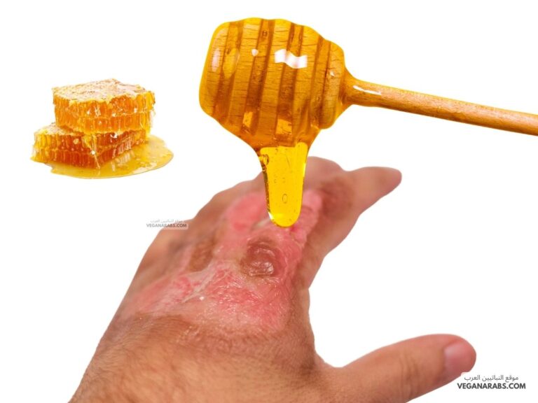فوائد العسل للحروق