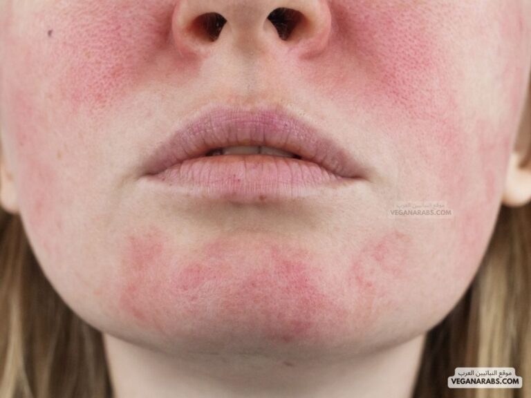 أسباب احمرار الوجه وسخونته Causes of Facial Redness and Heat
