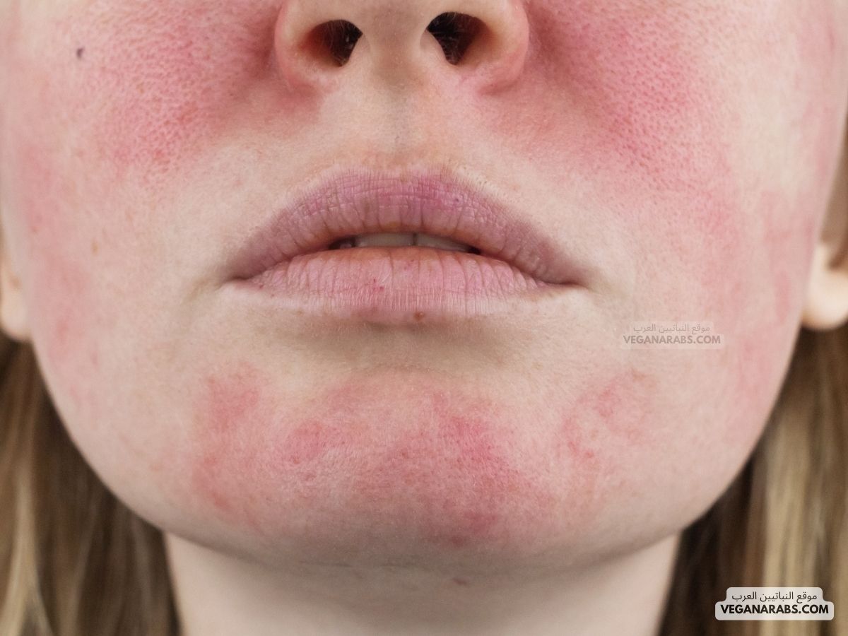 أسباب احمرار الوجه وسخونته Causes of Facial Redness and Heat