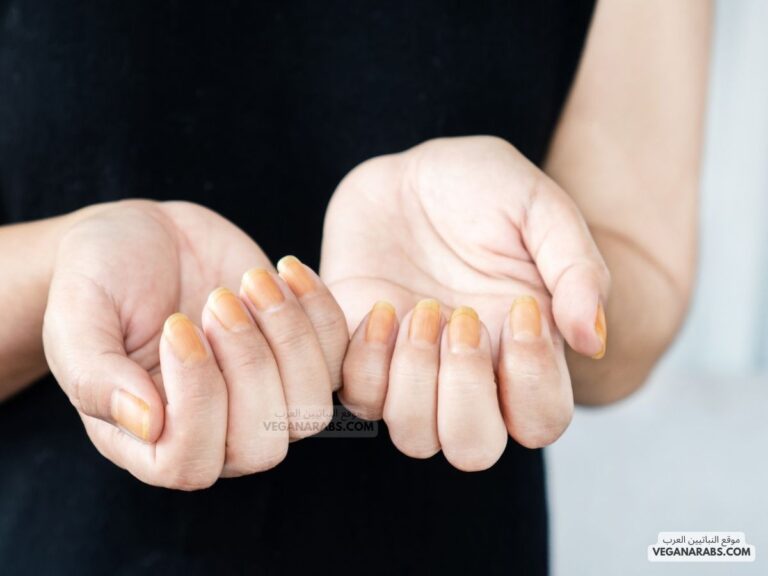 ما سبب اصفرار الأظافر