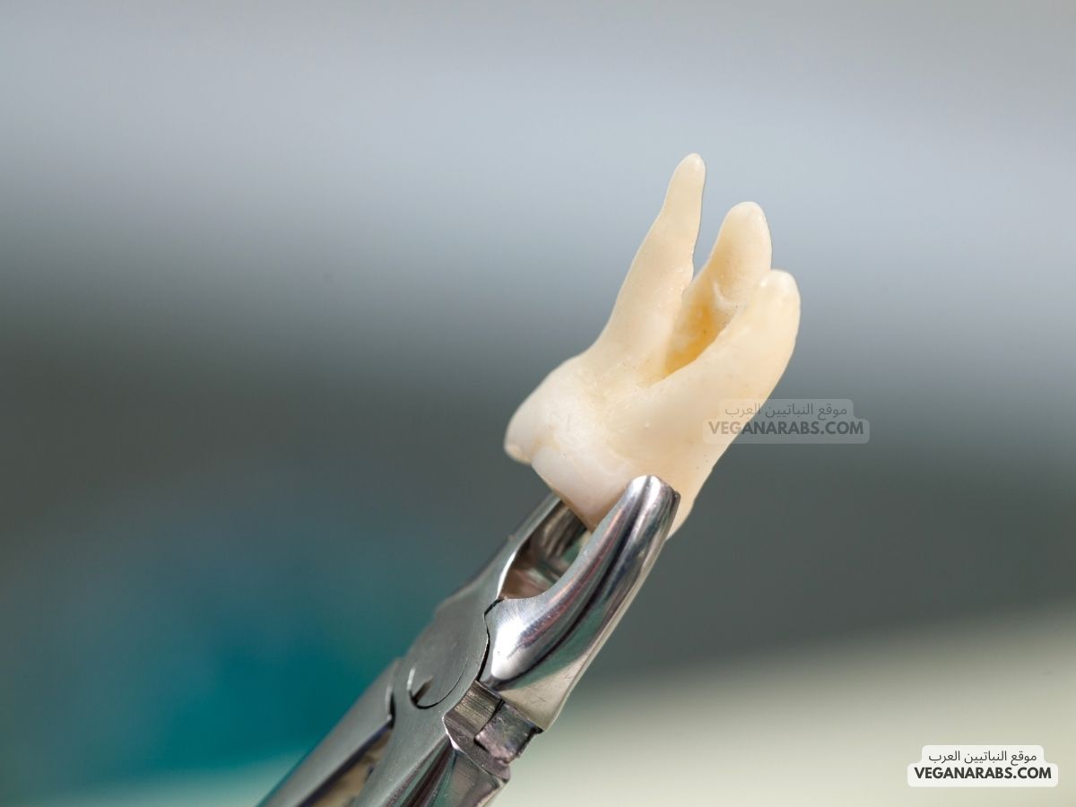 بعد خلع الضرس